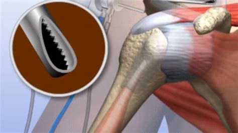 status post right shoulder arthroscopy icd 10.